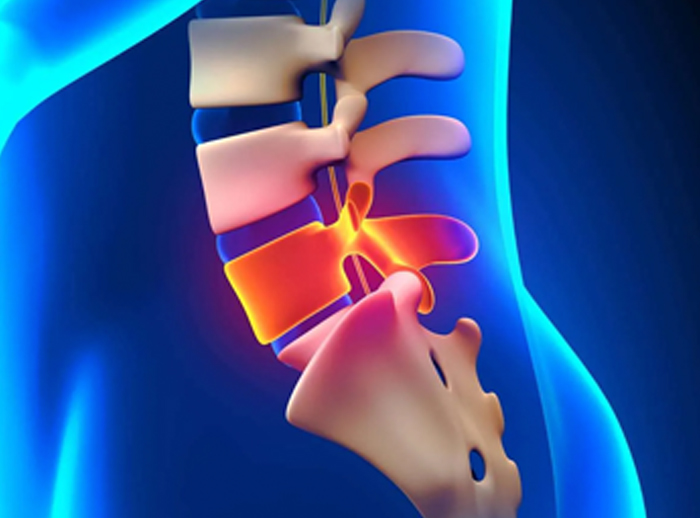 Microscopic Discectomy Recovery and Treatment in Delhi